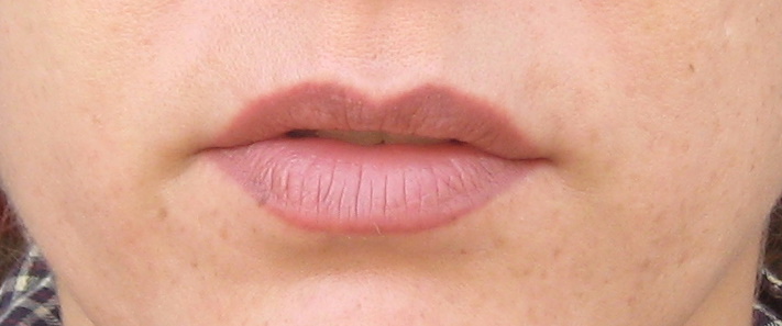 After permanent lip enhancement