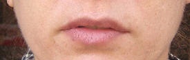 Before lip enhancement