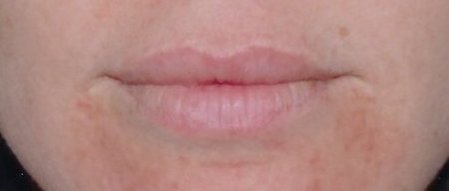 client before permanent lip color micropigmentation