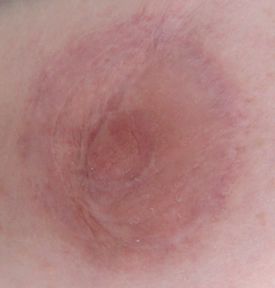 Areola-single-after