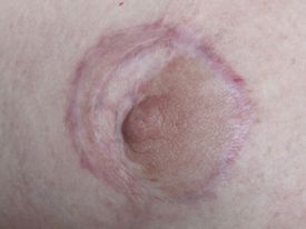 Areola-before scar camouflage