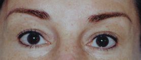 After permanent eyeliner and eyebrows
