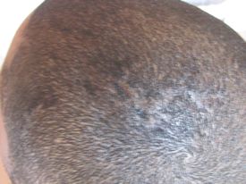 After scalp camouflage