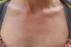 Scars After Two Applications