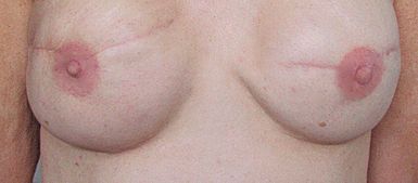 areola-after