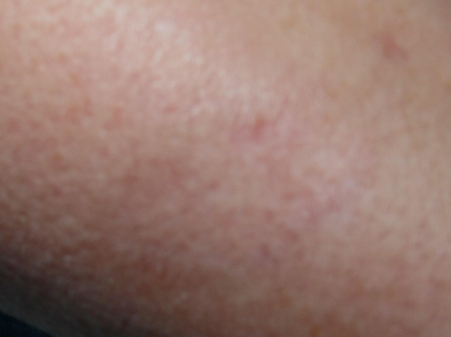 arm scar after one procedure